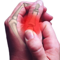 Artrite - Inflamação das articulações